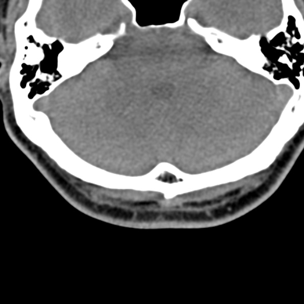Cervical spondylodiscitis (Radiopaedia 28057-29489 Axial non-contrast 1).jpg