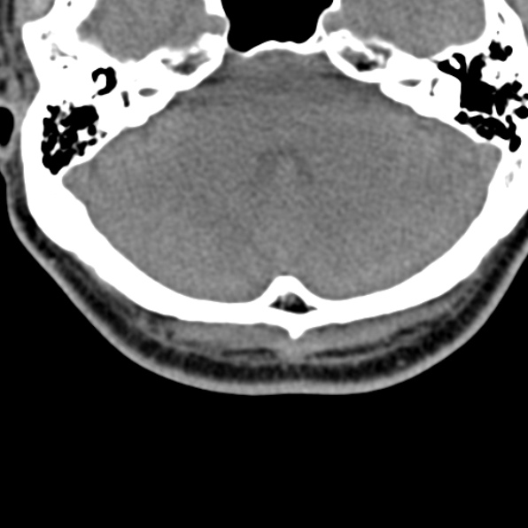 Cervical spondylodiscitis (Radiopaedia 28057-29489 Axial non-contrast 2).jpg