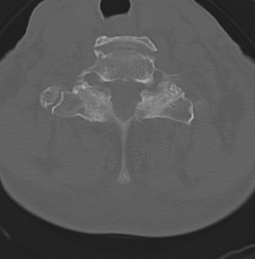 File:Cervical spondylolysis (Radiopaedia 49616-54811 Axial bone window 42).png