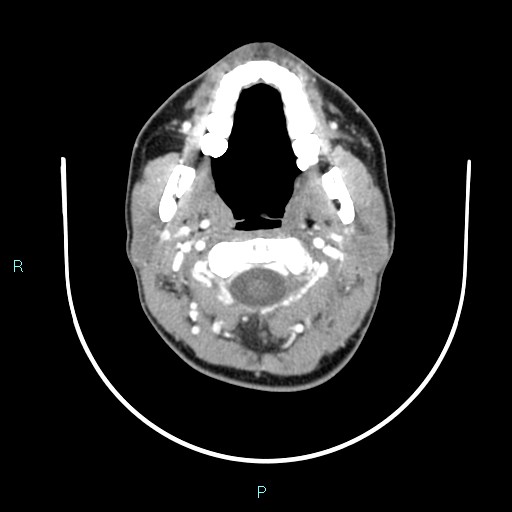File:Cervical thymic cyst (Radiopaedia 88632-105335 B 89).jpg