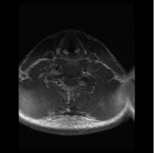 File:Cervical vertebrae metastasis (Radiopaedia 78814-91667 Axial T1 C+ 4).png