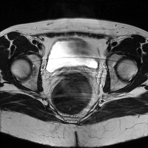 File:Cesarian section scar endometriosis (Radiopaedia 66520-75799 Axial T2 16).jpg