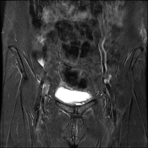 File:Cesarian section scar endometriosis (Radiopaedia 66520-75799 Coronal STIR 8).jpg