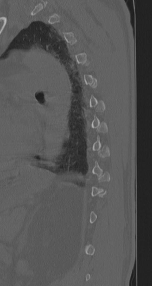 Chance fracture (Radiopaedia 33854-35020 Sagittal bone window 23).png