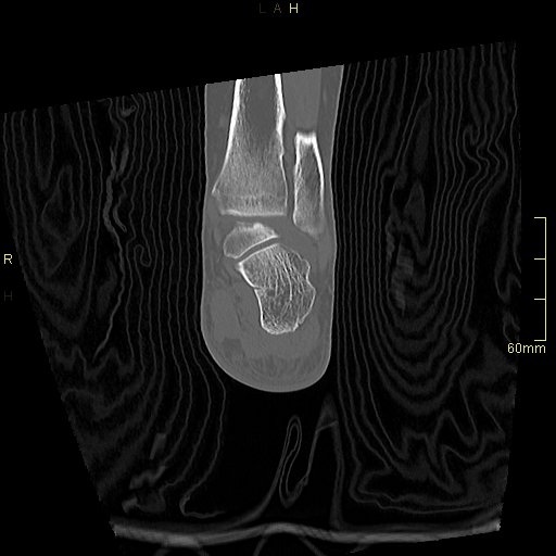 File:Chaput tubercle fracture (Radiopaedia 80319-93956 Coronal non-contrast 46).jpg