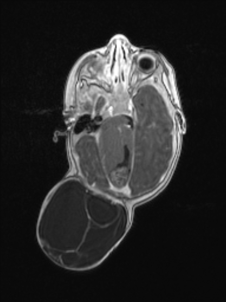 Chiari III malformation with occipital encephalocele (Radiopaedia 79446-92559 Axial T1 C+ mpr 39).jpg