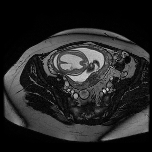 Chiari II malformation - fetal MRI (Radiopaedia 68099-77581 Axial Fiesta 42).jpg