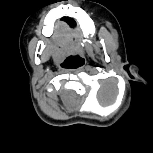 Chiari I with syrinx and skull base anomalies (Radiopaedia 89444-106412 Axial non-contrast 47).jpg