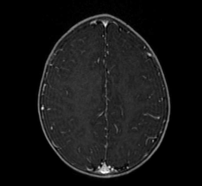 Chiasmatic-hypothalamic glioma (Radiopaedia 90079-107252 Axial T1 C+ 67).jpg