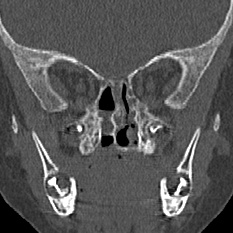 File:Choanal atresia (Radiopaedia 88525-105975 Coronal bone window 64).jpg