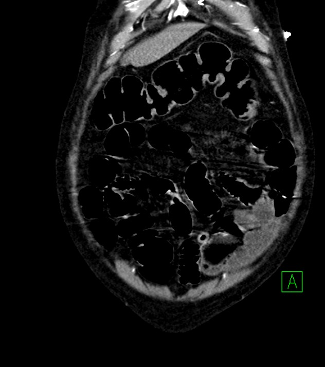 Cholangiocarcinoma with cerebral metastases (Radiopaedia 83519-98629 E 17).jpg