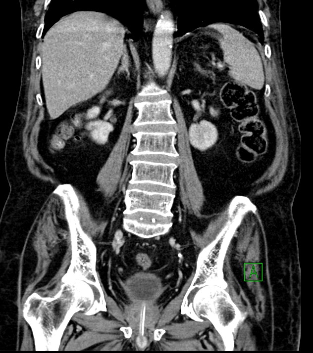 Cholangiocarcinoma with cerebral metastases (Radiopaedia 83519-98629 G 51).jpg