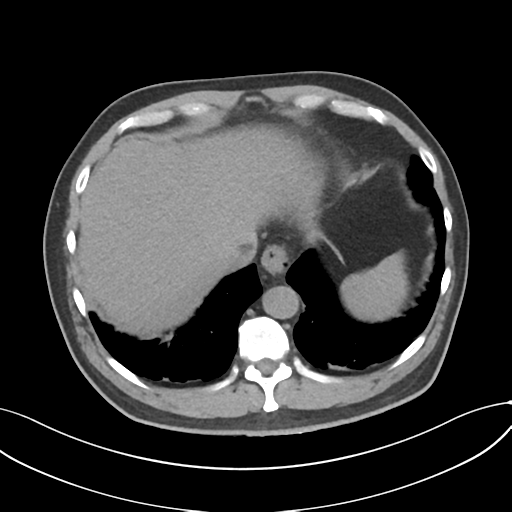 File:Cholecystitis with focal perforation and hepatic abscess (Radiopaedia 37189-38945 Axial non-contrast 12).png