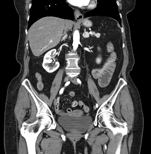 File:Cholecystoduodenal fistula due to calculous cholecystitis with gallstone migration (Radiopaedia 86875-103077 B 26).jpg
