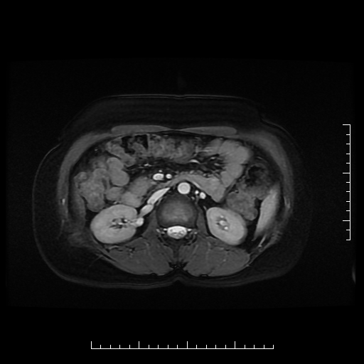 File:Choledochal cyst with chronic calcific pancreatitis (Radiopaedia 18245-18062 Axial T2 12).png