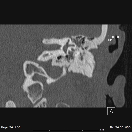 Cholesteatoma - external auditory canal (Radiopaedia 88452-105096 Coronal bone window 34).jpg