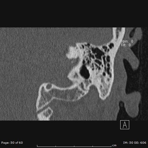 Cholesteatoma - external auditory canal (Radiopaedia 88452-105096 Coronal bone window 50).jpg