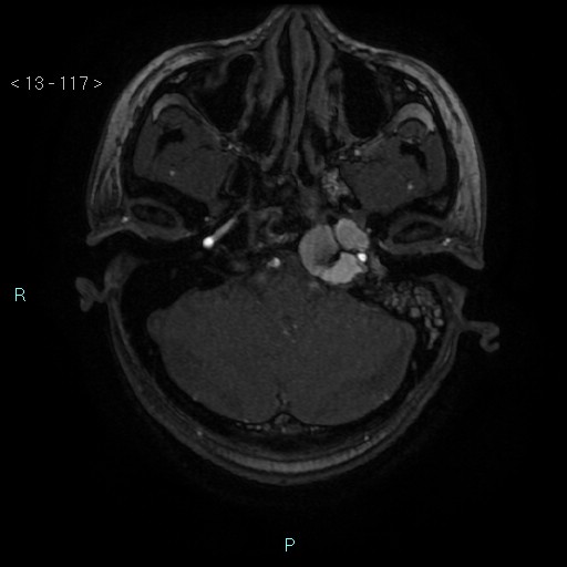 File:Cholesterol granuloma of the petrous apex (Radiopaedia 64358-73140 Axial TOF 3D 56).jpg