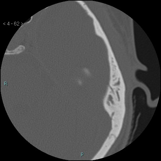 Cholesterol granuloma of the petrous apex (Radiopaedia 64358-73141 Axial bone window 30).jpg