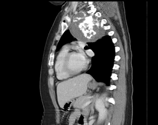 Chondrosarcoma - chest wall (Radiopaedia 65192-74199 B 26).jpg