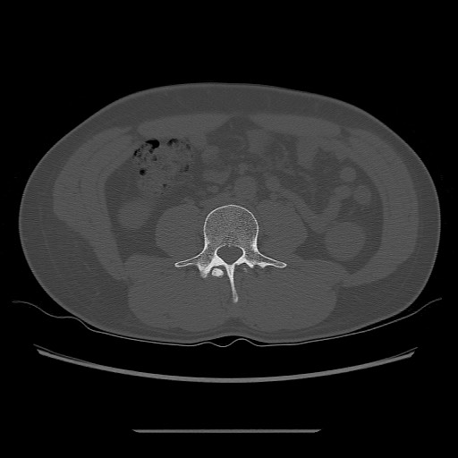 File:Chondrosarcoma of iliac wing (Radiopaedia 63861-72599 Axial bone window 6).jpg