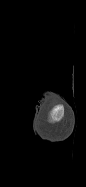 Chopart fracture (Radiopaedia 35347-36851 Coronal bone window 2).jpg