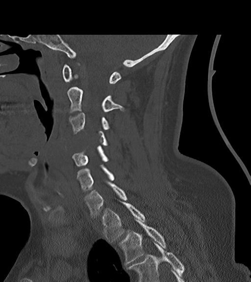 File:Chordoma (C4 vertebra) (Radiopaedia 47561-52188 Sagittal bone window 46).png