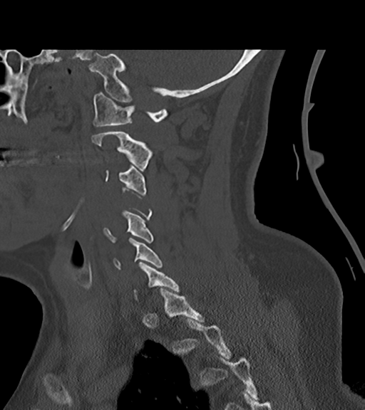 File:Chordoma (C4 vertebra) (Radiopaedia 47561-52188 Sagittal bone window 51).png