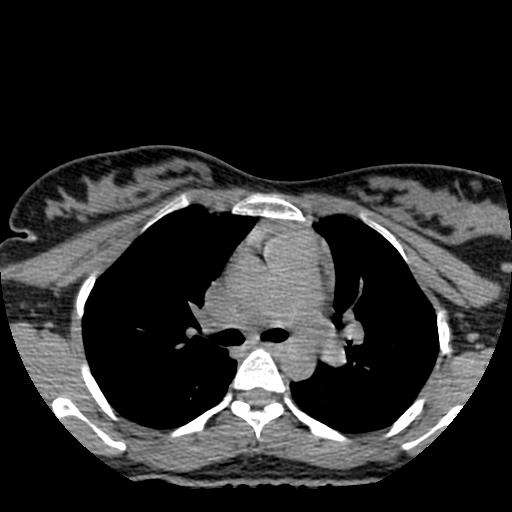 File:Choriocarcinoma of ovary with cerebral and pulmonary metastases (Radiopaedia 25983-26119 Axial non-contrast 121).jpg
