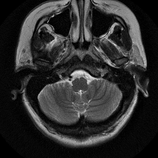File:Choroid plexus xanthogranuloma (Radiopaedia 17650-17386 T2 21).jpg