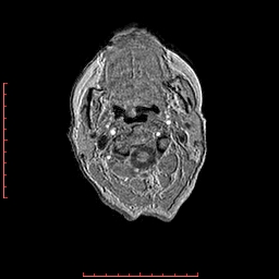 File:Choroid plexus xanthogranuloma (Radiopaedia 67843-77270 Axial T1 174).jpg