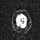 Choroid plexus xanthogranuloma - unilateral (Radiopaedia 85632-101393 Axial ADC 58).jpg