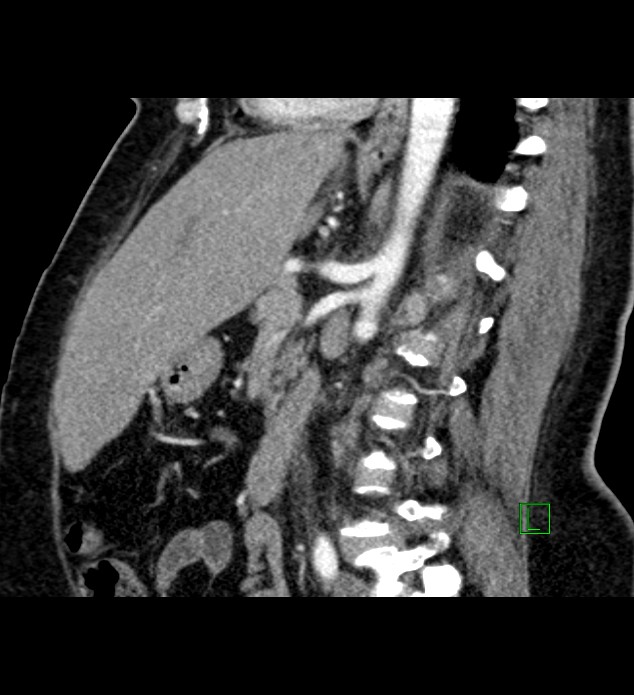 Chromophobe renal cell carcinoma (Radiopaedia 84239-99519 D 57).jpg