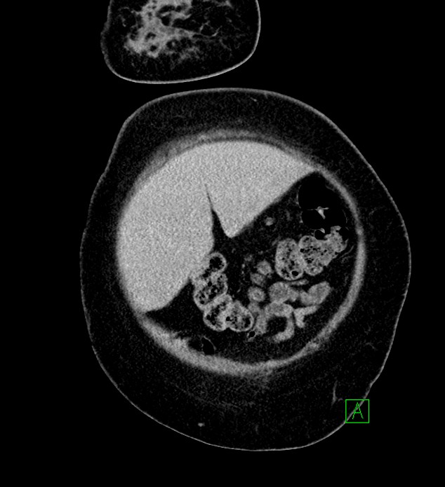 Chromophobe renal cell carcinoma (Radiopaedia 84239-99519 F 13).jpg