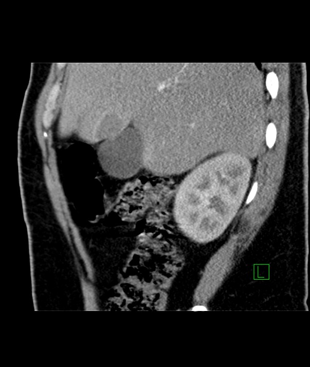 Chromophobe renal cell carcinoma (Radiopaedia 84255-99542 E 46).jpg