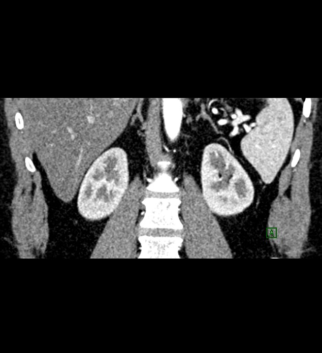 Chromophobe renal cell carcinoma (Radiopaedia 84286-99573 E 58).jpg