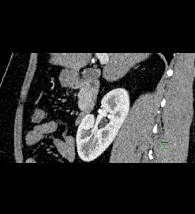 Chromophobe renal cell carcinoma (Radiopaedia 84286-99573 F 109).jpg