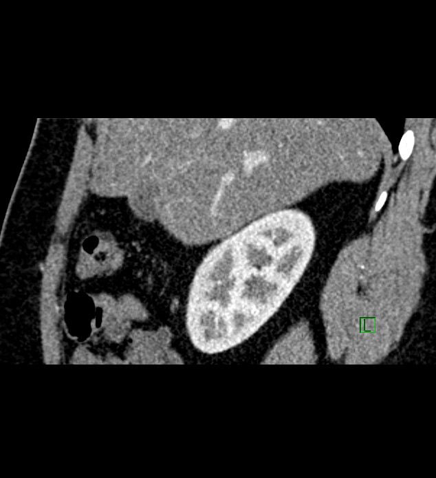Chromophobe renal cell carcinoma (Radiopaedia 84286-99573 F 127).jpg