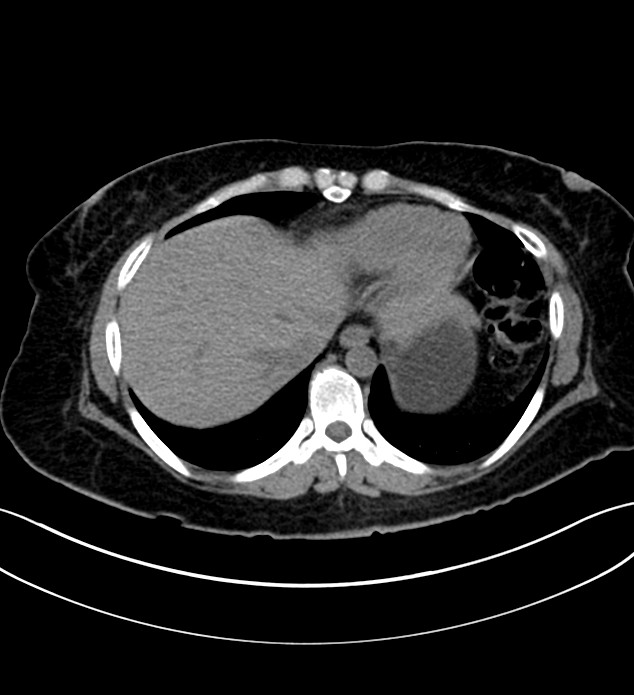 Chromophobe renal cell carcinoma (Radiopaedia 84290-99582 Axial non-contrast 19).jpg