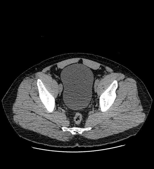Chromophobe renal cell carcinoma (Radiopaedia 84337-99693 Axial non-contrast 139).jpg