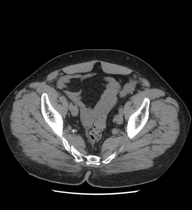 Chromophobe renal cell carcinoma (Radiopaedia 86879-103083 Axial non-contrast 109).jpg