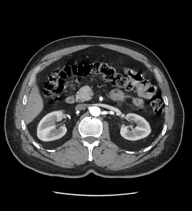 Chromophobe renal cell carcinoma (Radiopaedia 86879-103083 B 55).jpg