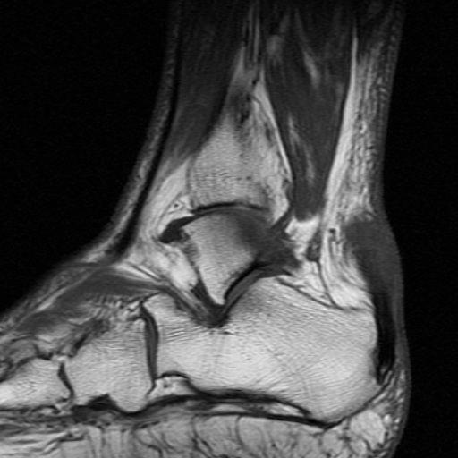 File:Chronic Achilles tendon rupture (Radiopaedia 15262-15100 Sagittal T1 4).jpg