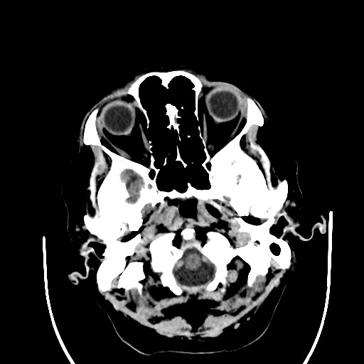 Chronic bilateral subdural hygroma (Radiopaedia 85801-101622 Axial non-contrast 26).jpg