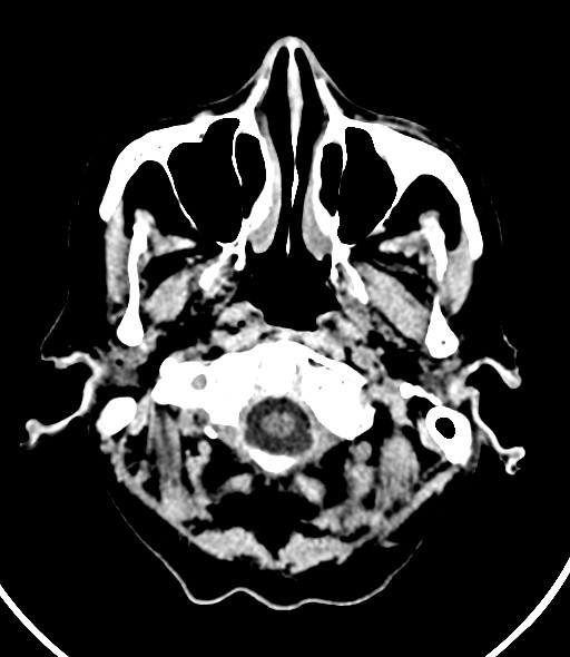 Chronic bilateral subdural hygroma (Radiopaedia 85801-101623 Axial non-contrast 56).jpg