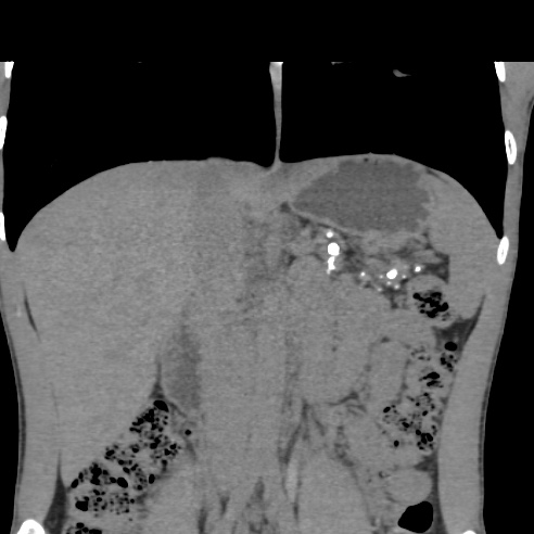 File:Chronic calcific pancreatitis (Radiopaedia 56280-62953 Coronal non-contrast 14).jpg