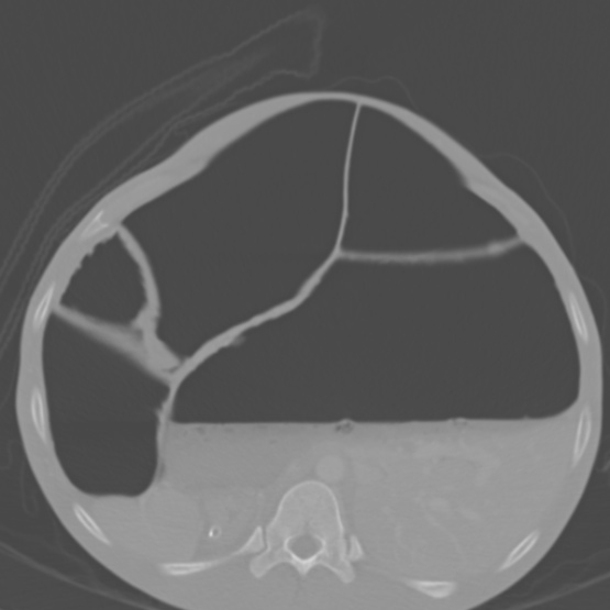 Chronic large bowel pseudo-obstruction (Radiopaedia 43181-46492 Axial bone window 58).jpg