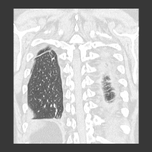 Chronic lung allograft dysfunction - restrictive form (Radiopaedia 60595-68316 Coronal lung window 80).jpg
