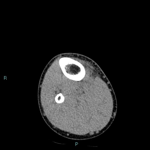 File:Chronic osteomyelitis (with Brodie abscess) (Radiopaedia 76405-88111 A 37).jpg