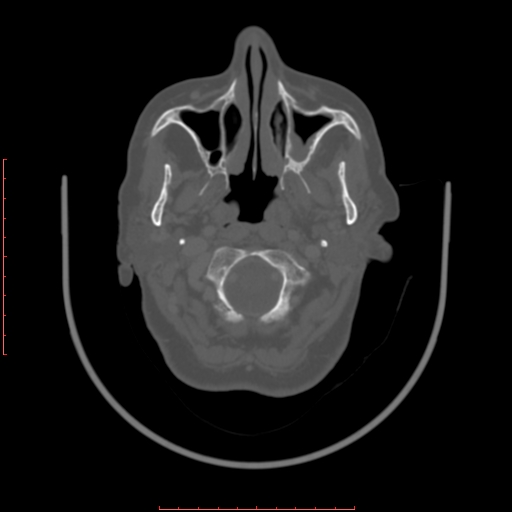File:Chronic osteomyelitis - maxilla (Radiopaedia 23783-23927 Axial bone window 103).jpg
